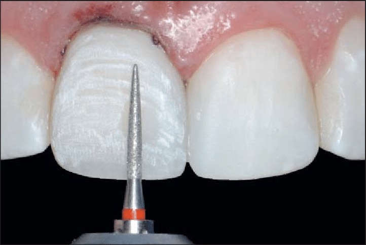 Mani Diamond Burs - Cr Polishing Series