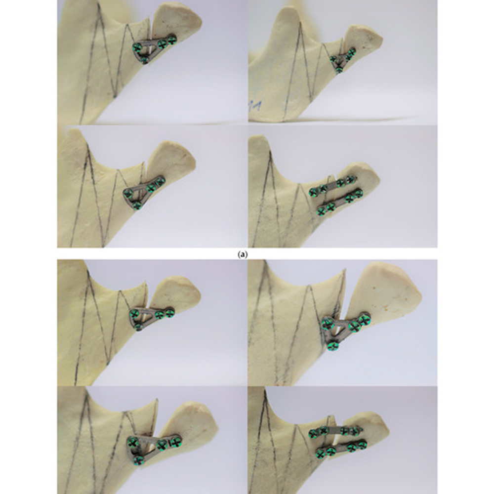 SK Surgicals SS Mini Bone Delta Plates - 2mm ( 300.501S)