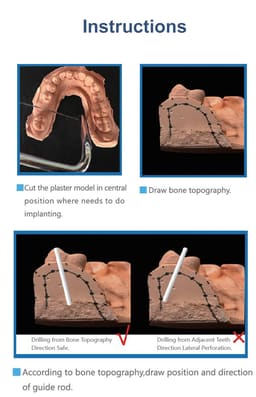 Cotisen Dental Implant Guide System Kit - 8