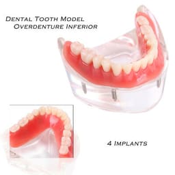 iDENTical Mandibular Overdenture Model with 4 Implants M6003 - 6