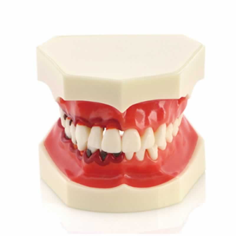 iDENTical Periodontal Disease Model M4025