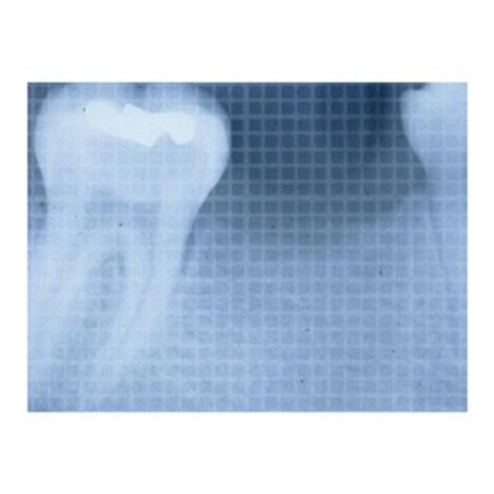 Dental IOPA X-Ray Grid