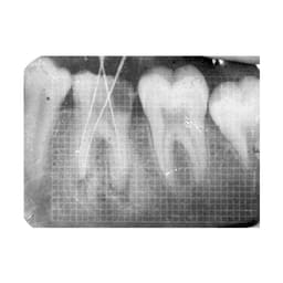 Dental IOPA X-Ray Grid - 3