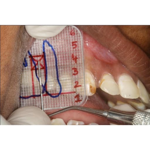 Dental IOPA X-Ray Grid