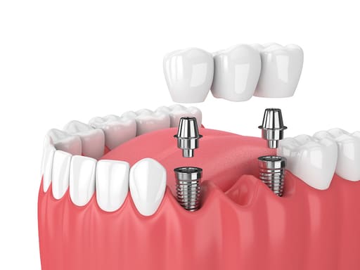 Xcem Dental Implant Transfer Abutment 6.5mm - Non Hex 