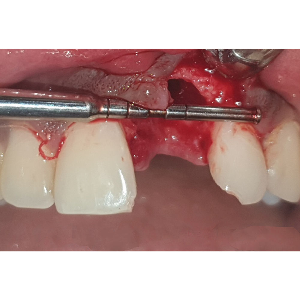 GDC Depth Measuring Gauge 1.2Mm PCP1301