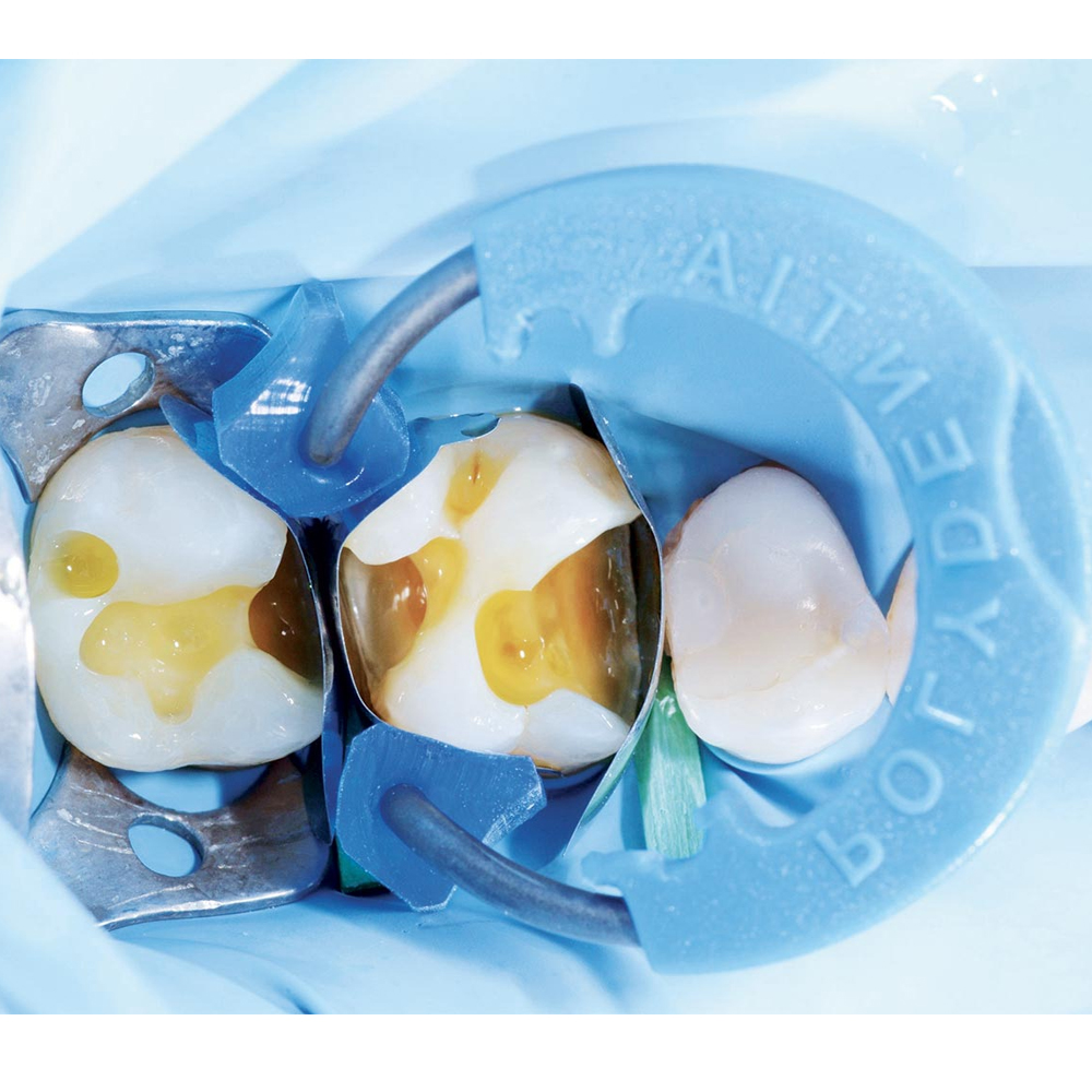 Polydentia Diamond24 Silicone Tubes For MyRing Classico