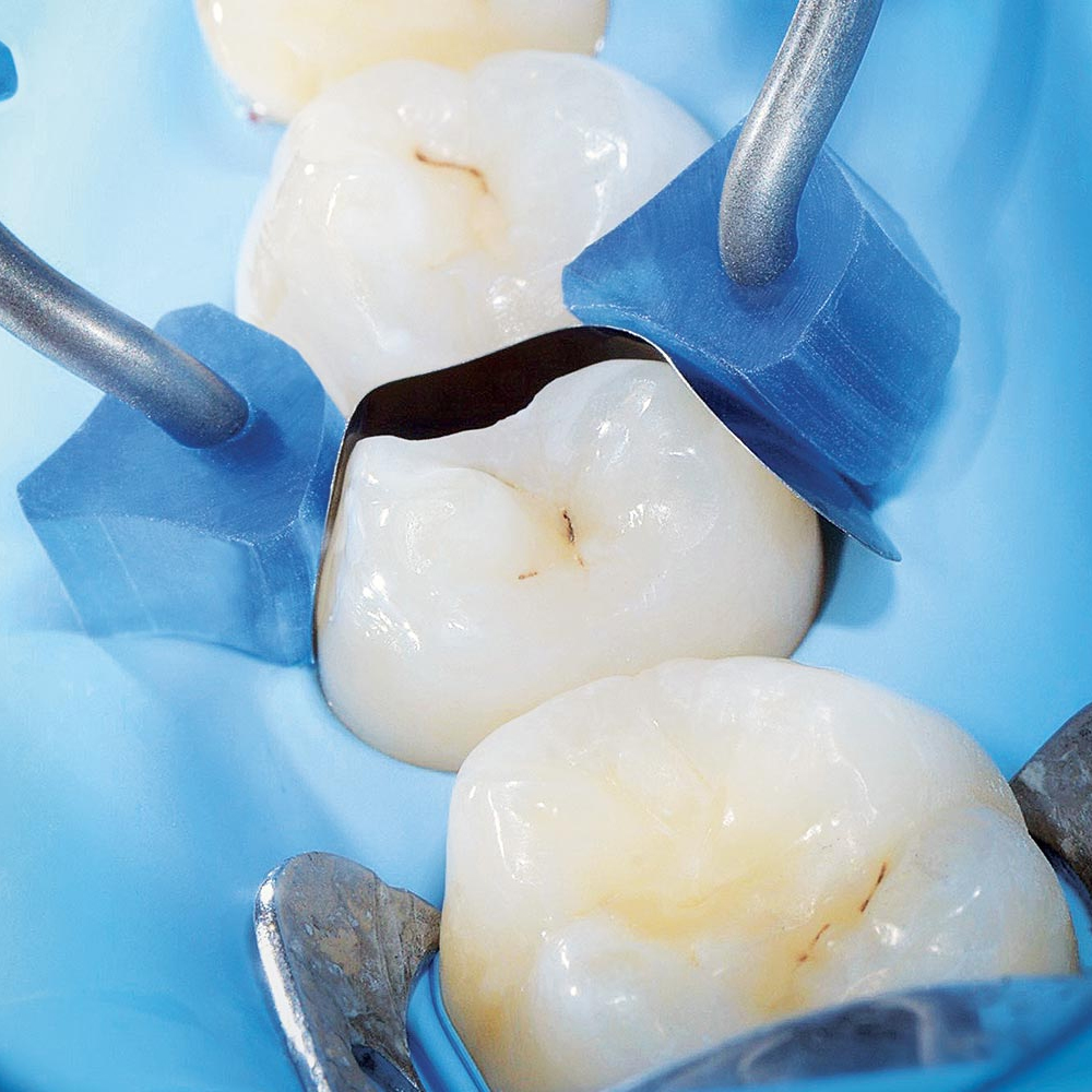 Polydentia Diamond24 Silicone Tubes For MyRing Classico