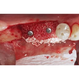 Julldent Membrane Stabilizing Kit and Refills - 5