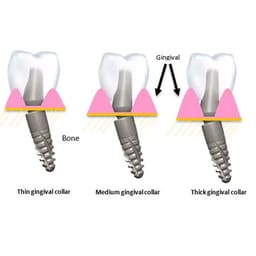 Xcem Dental Implant Angled Abutment Type B 4.5mm - Hex  - 3