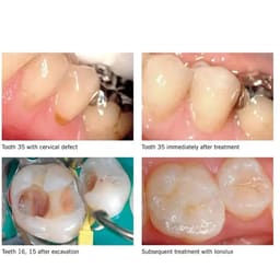 SafeEndo GlassyRestore Restorative Cement - 4