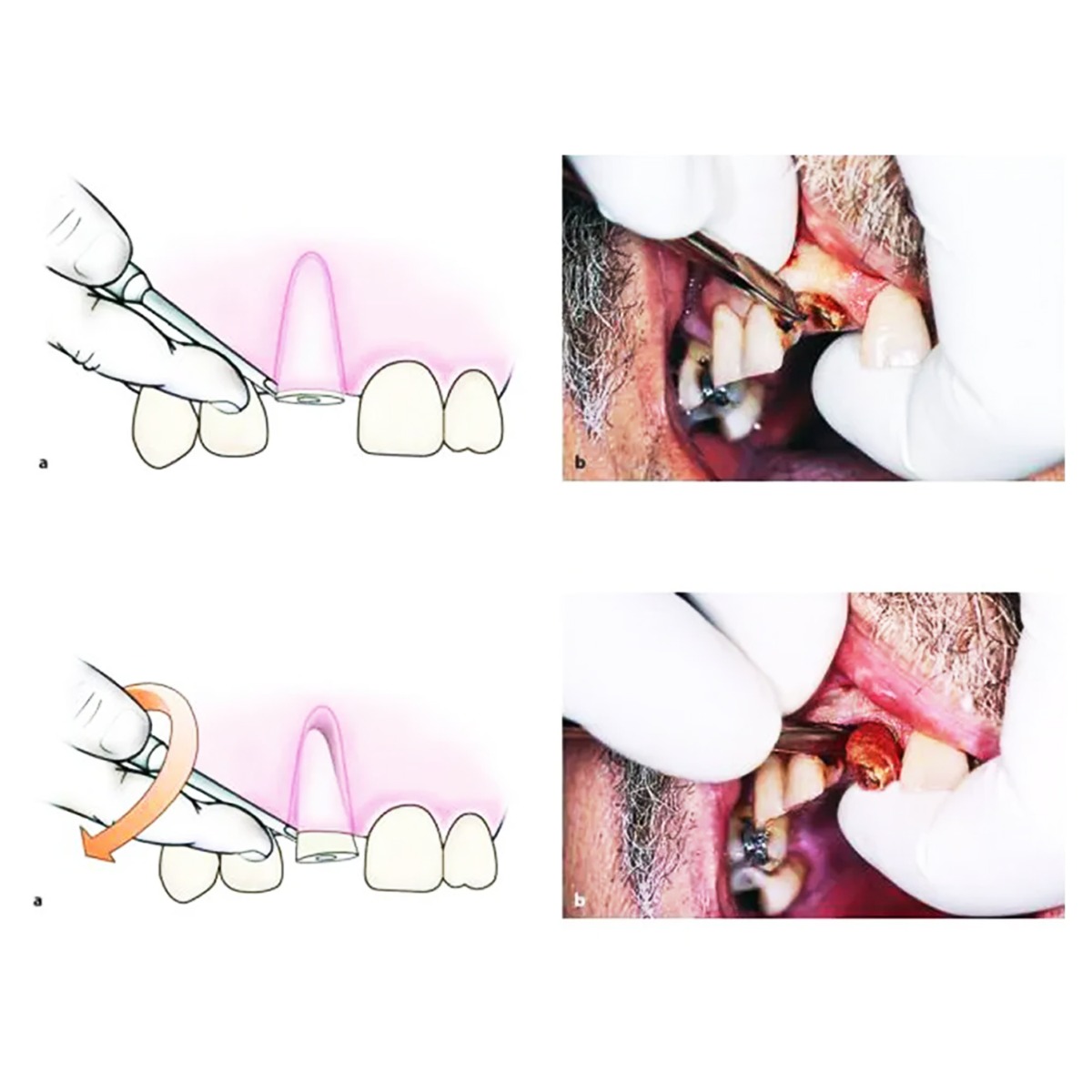 Veecare Hylin Root Elevators