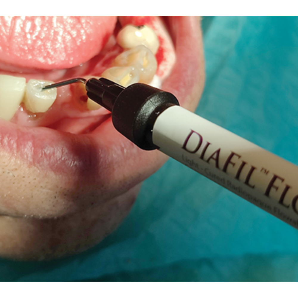 Diadent Diafil Flow Flowable Composite Refills