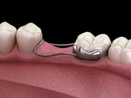 Kids-e-Dental Bands with tube attached Refills - 7