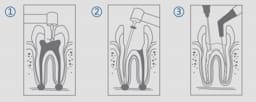 Cotisen Endodontic Aspirator Tip ( Pack of 1 ) - 15