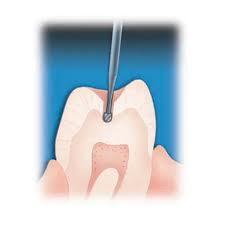 Prima Dental Round Bur (Carbide)