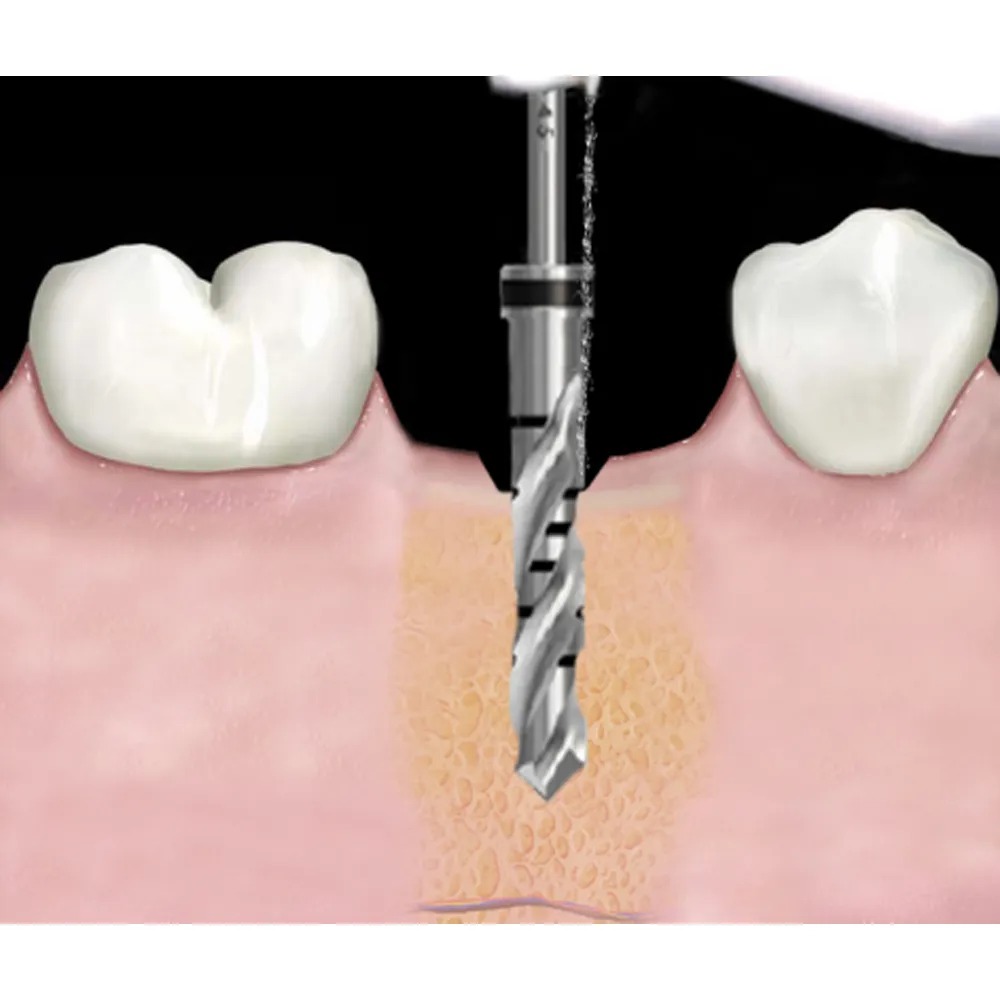 SK Surgicals Surgical Bone Drill Bites