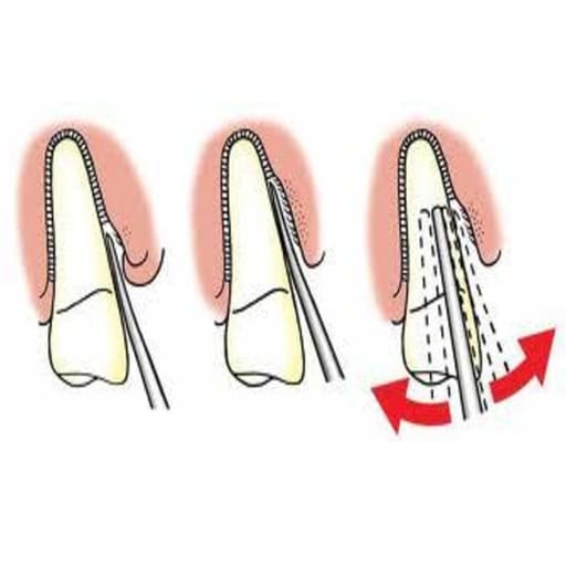 GDC Luxatip - 5mm Straight (L5s)