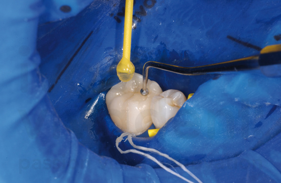 Ivoclar Optrastick Refill 48