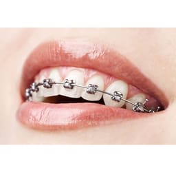 ET Dental MBT 022 Mini Brackets Kit (Non-Extraction) - 10