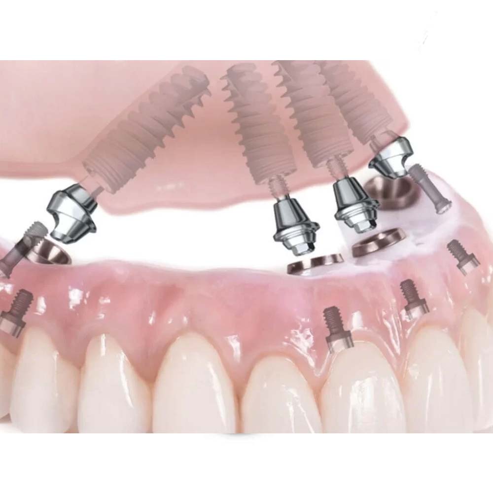 Xcem Conical Multi Angled Abutment Mini - Hex