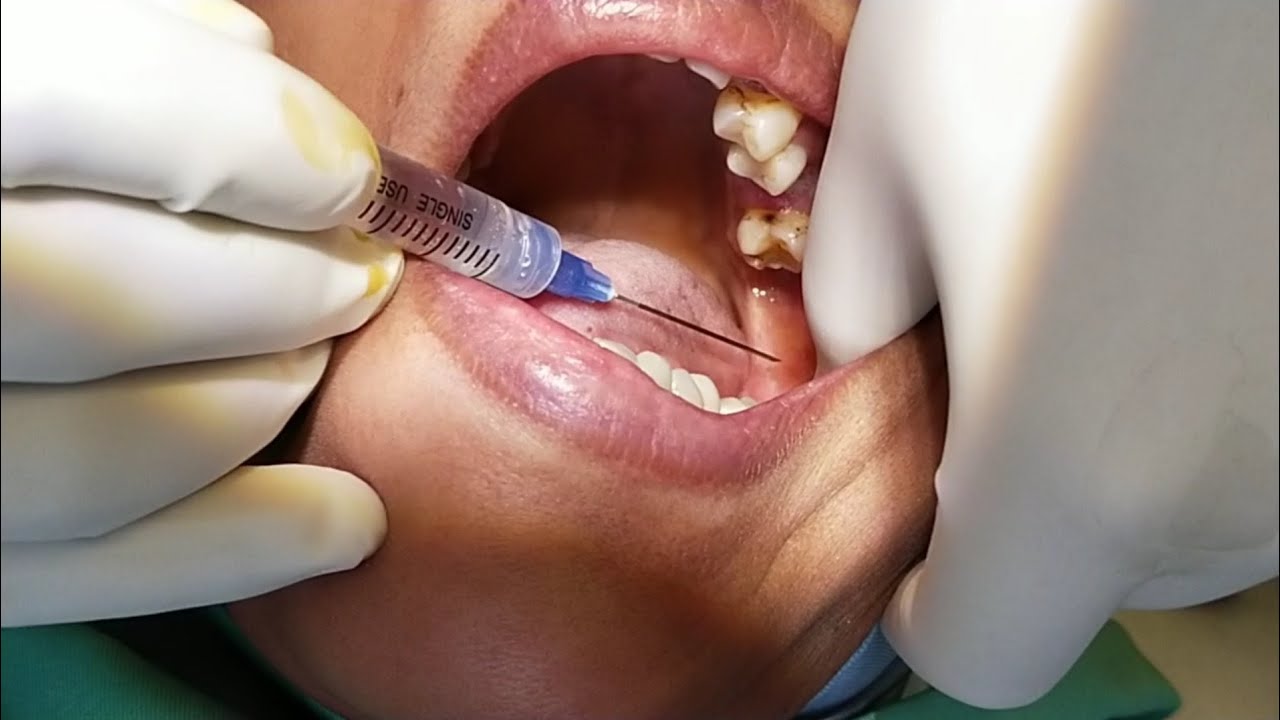 HMD Unolok Syringe 2.5ml | 24 Gauge | 1 Inch Needle