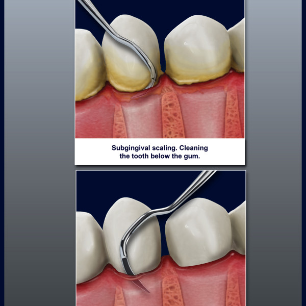 Api+ Curette MC Call Hollow Handle