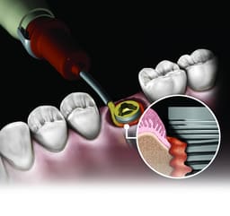 Novabone Dental Putty Cartridge Form - 8