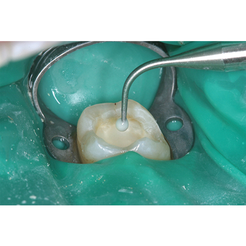 GDC Dental Dycal Applicator D/E With Spatula-1 (SP60616)