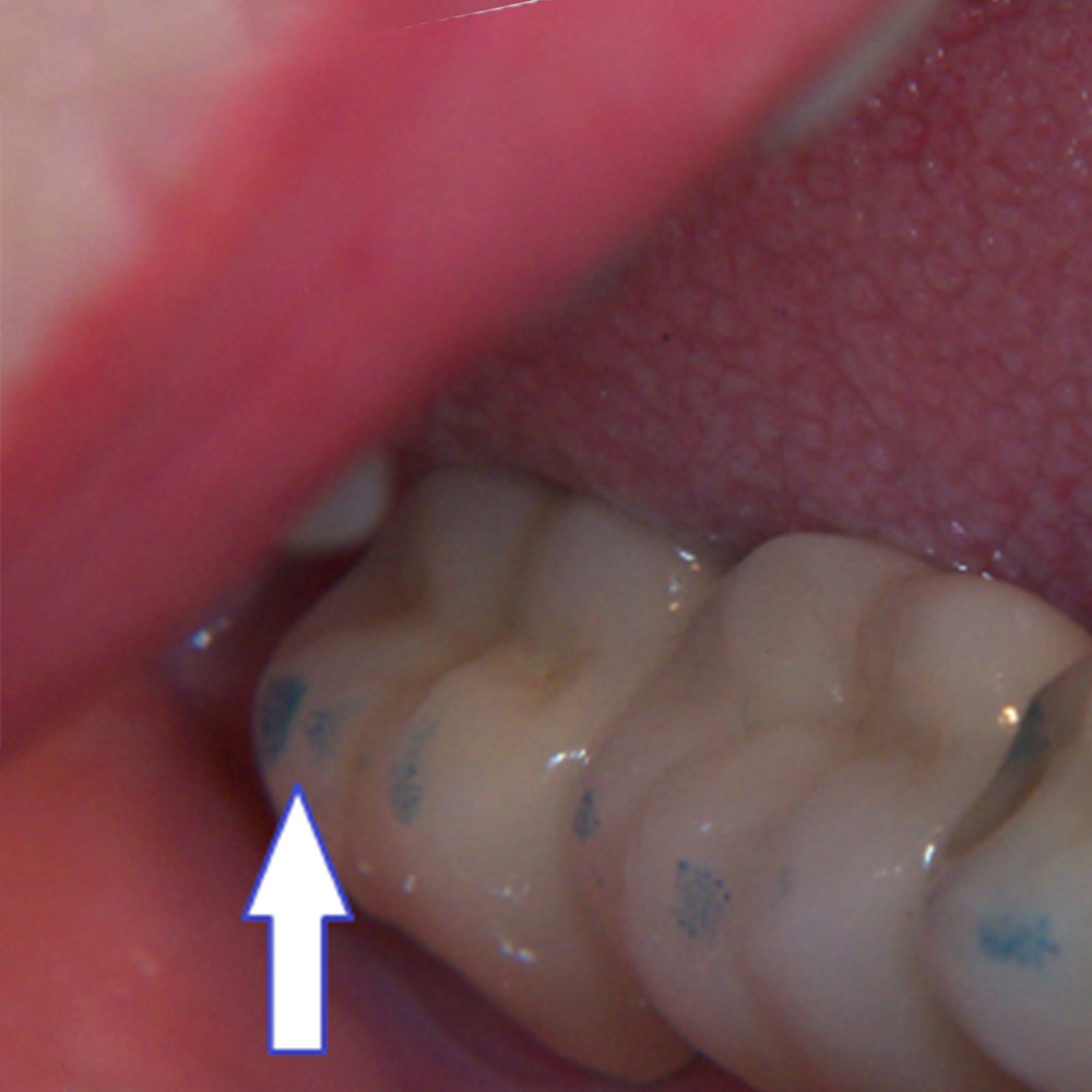 ET Dental Articulating Paper 