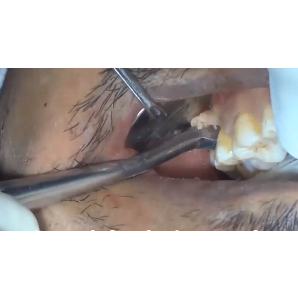 GDC Root Elevators Cryer - Right Premium (E32p)