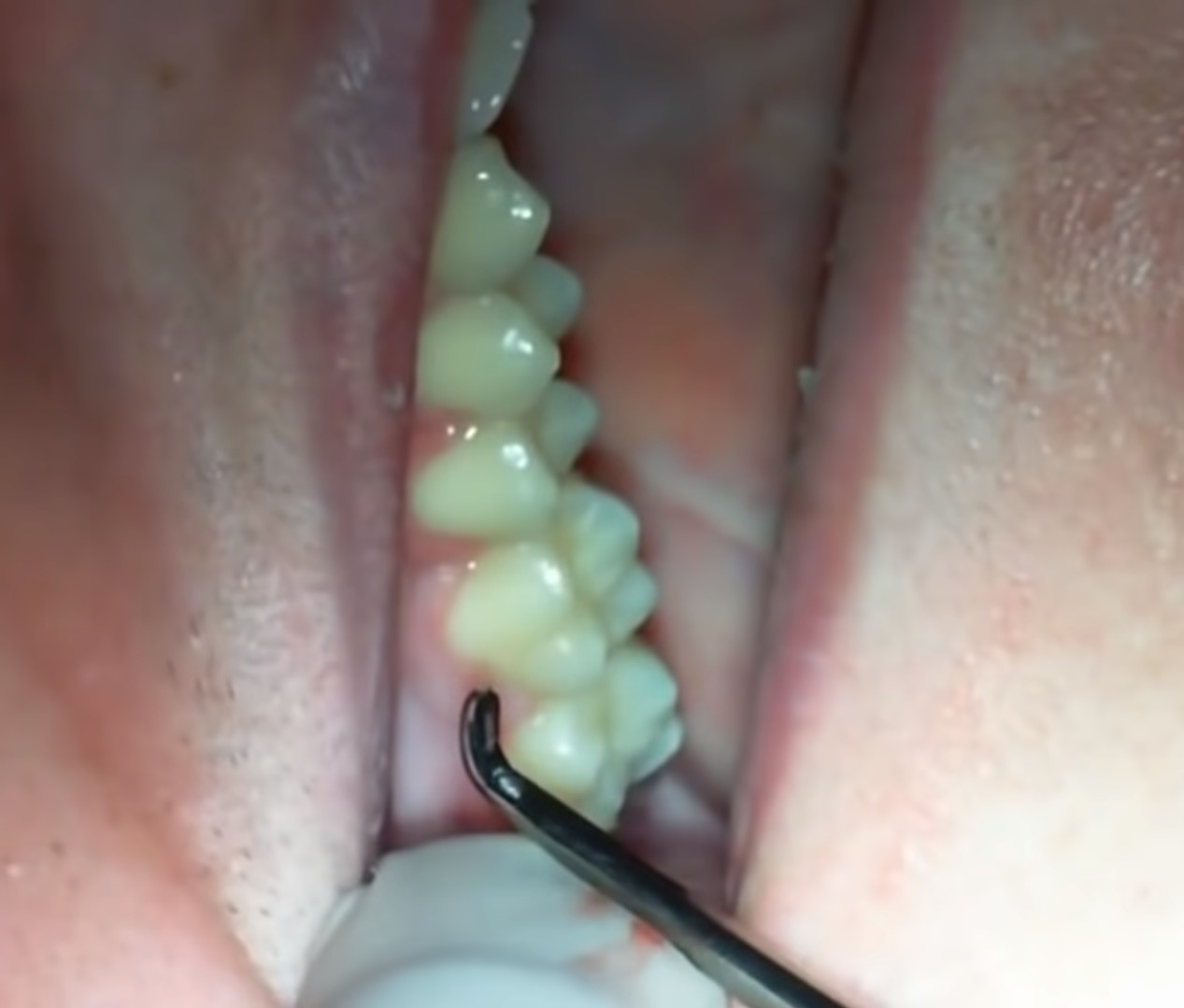 Waldent Root Elevators Warwick James Set of 3 (K2/3)