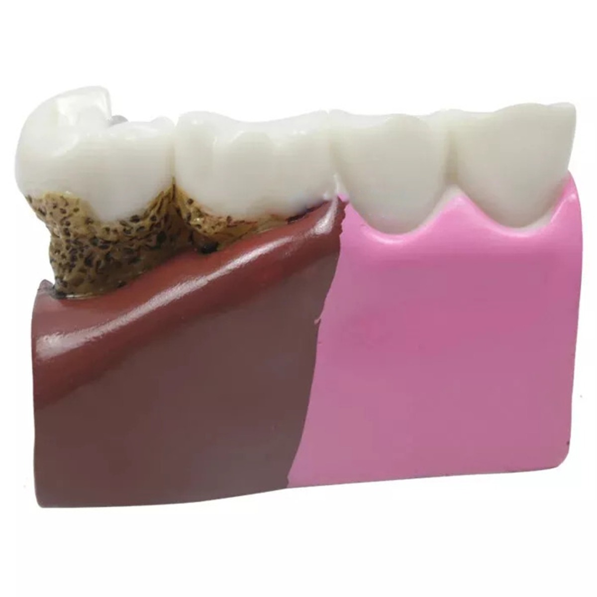 iDENTical Diseased Teeth and Gums Model M4029