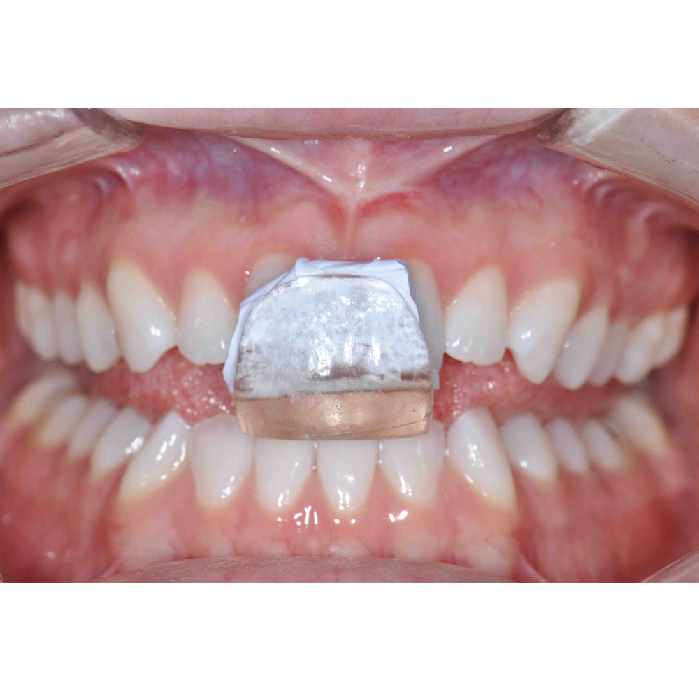 Maarc Eazy Tray 100gm  (9701/100)