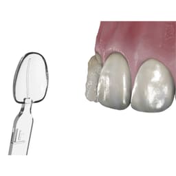 Waldent MyVeneer Composite Template System - 7