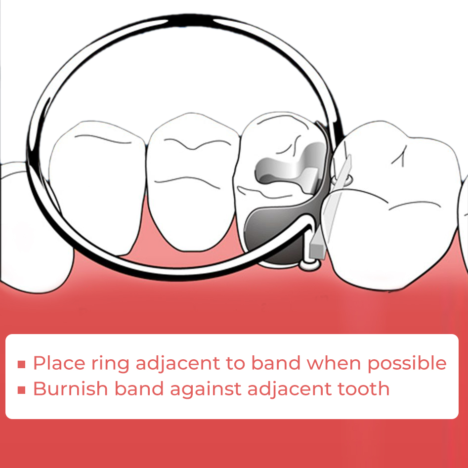 ET Dental Sectional Contoured Matrices Kit