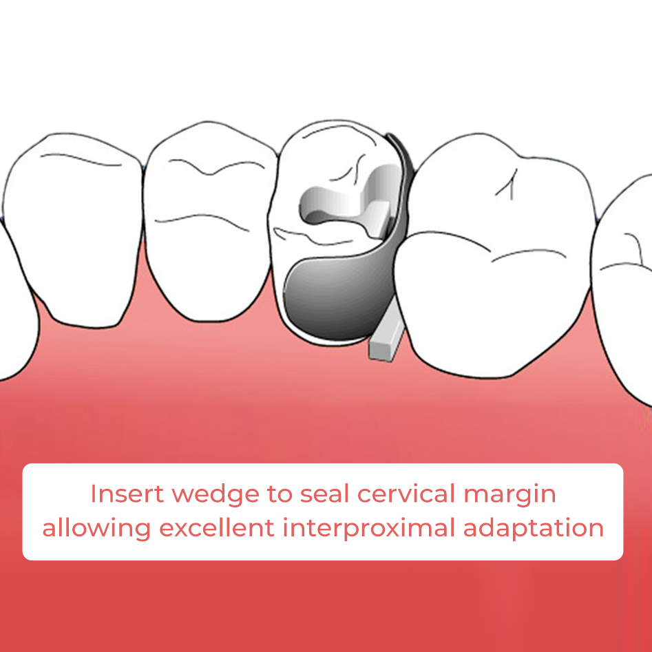 ET Dental Sectional Contoured Matrices Kit