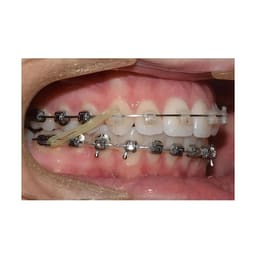 U Ortho Intraoral Elastics ( Pack Of 100 ) - 9