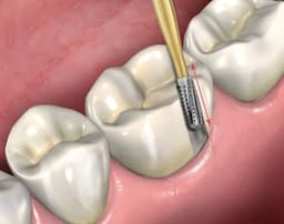Prima Dental Predator Turbo Crown Removal Kit - 4