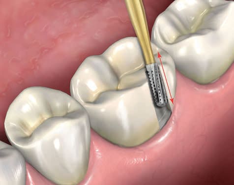 Prima Dental Predator Turbo Crown Removal Kit