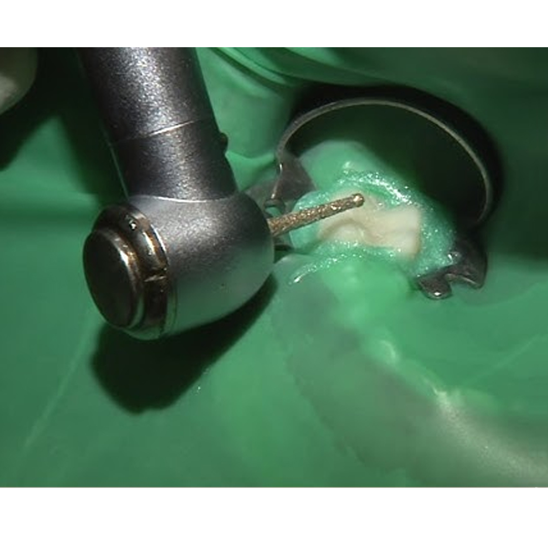 SuperEndo Endo Access Bur - 14