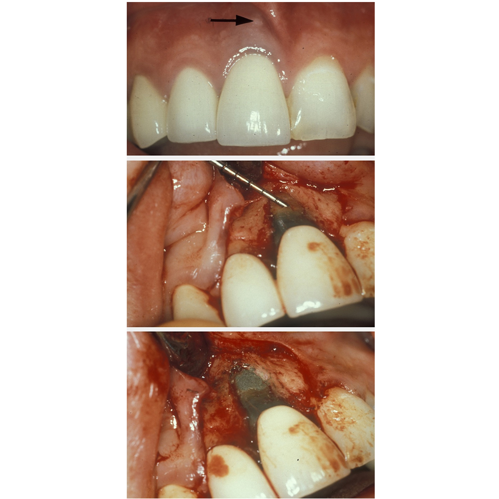 GDC Endo Surgical S/13 With Cassette (Esiwc13)