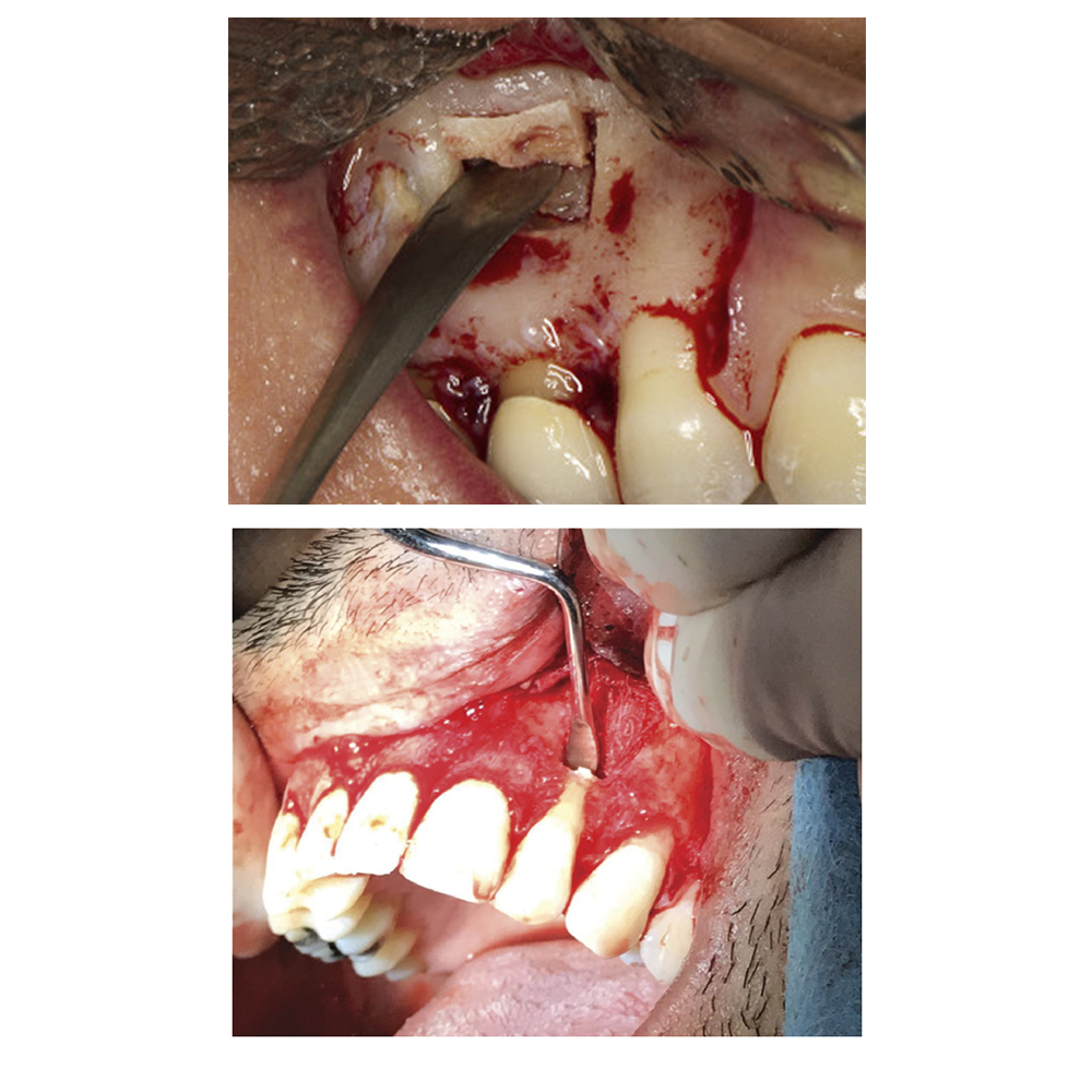 GDC Endo Surgical S/13 With Cassette (Esiwc13)