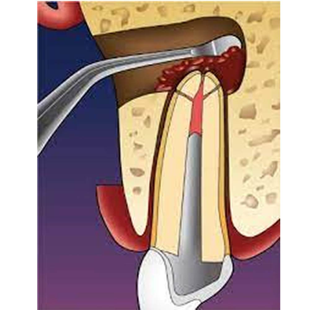 GDC Endo Surgical S/13 With Cassette (Esiwc13)