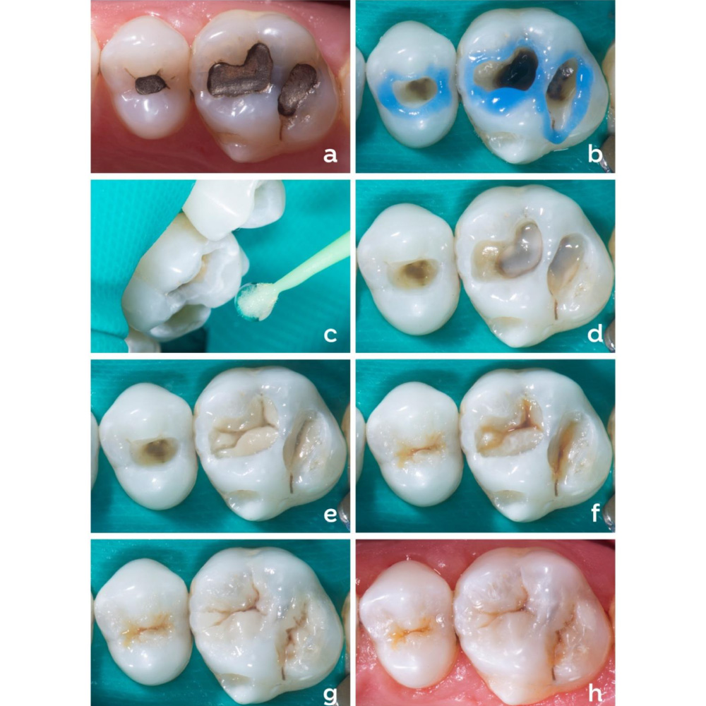 Septodont Endure Nano Hybrid Composite Kit