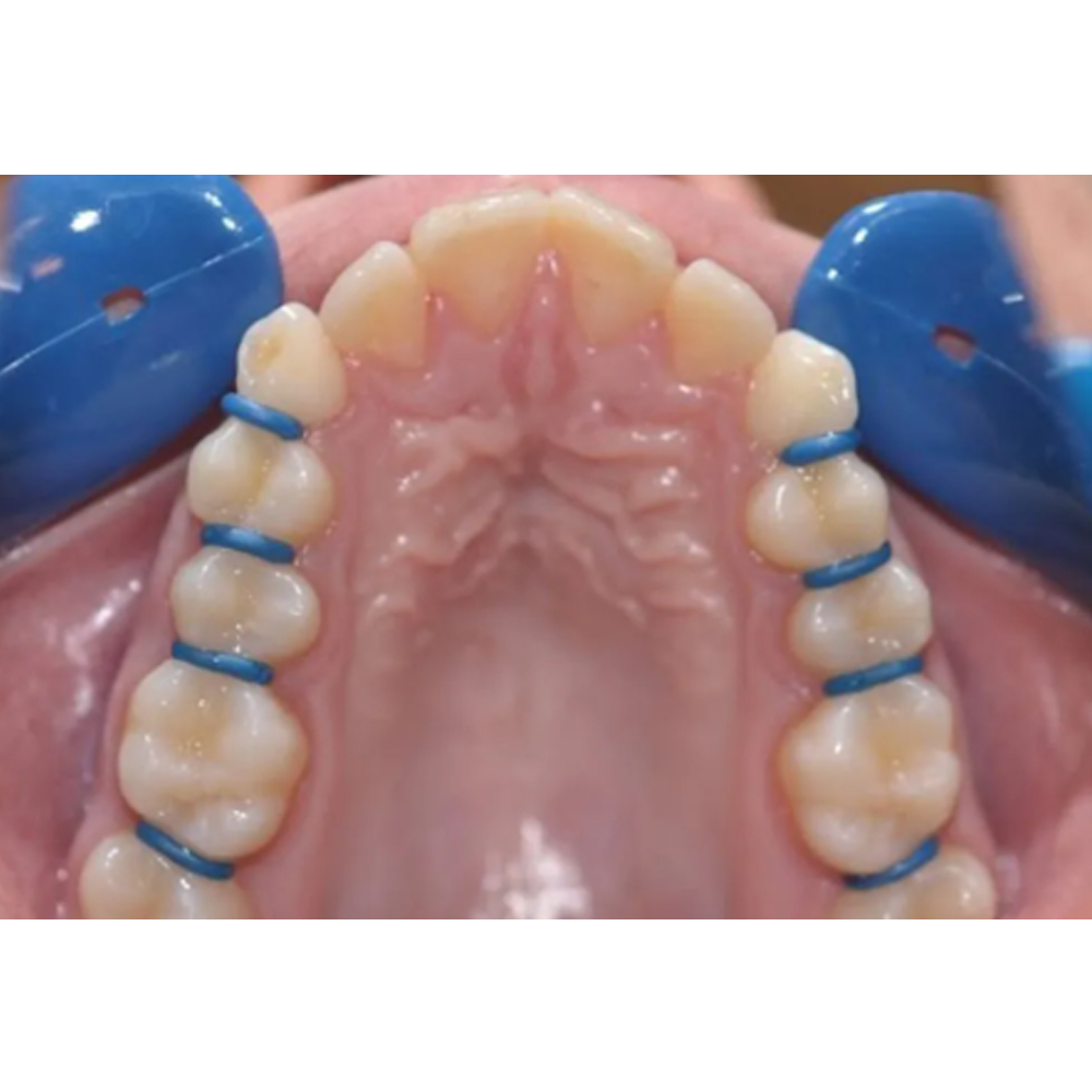 Koden Othro Elastic Separators (Pack of 1000)