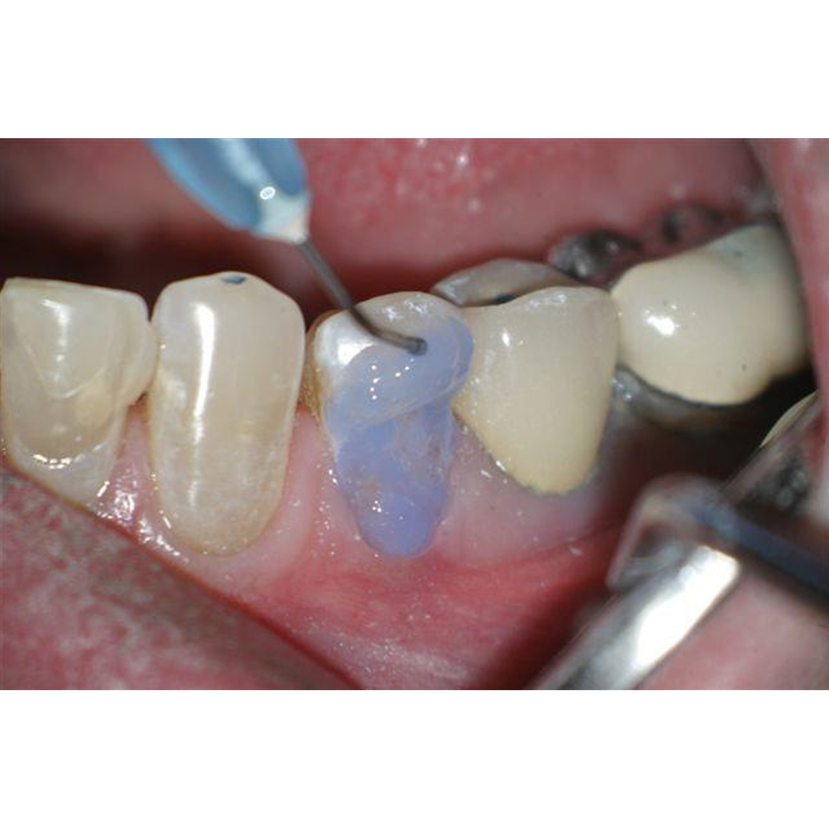 Bisco 32% Uni-Etch with BAC