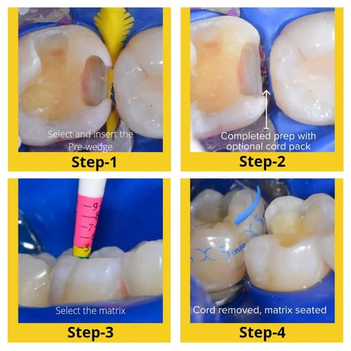 Bioclear Evolve Posterior Matrix Series