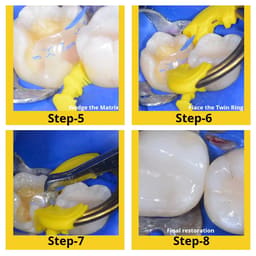 Bioclear Evolve Posterior Matrix Series - 14