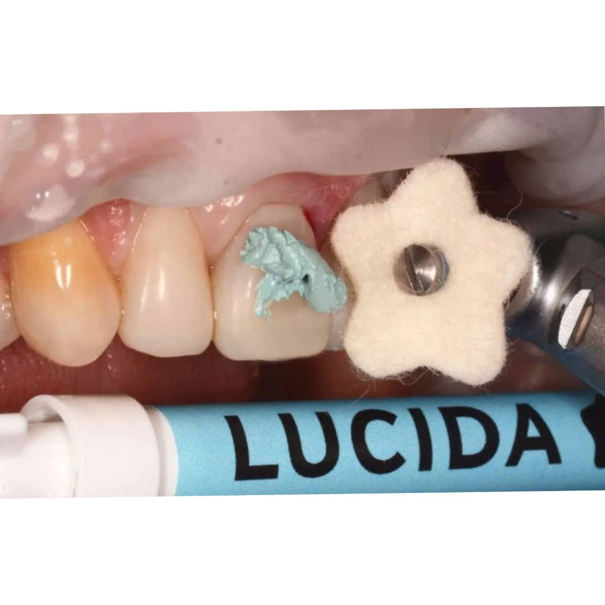 Diashine Lucida Composite Gloss System Intro Kit 